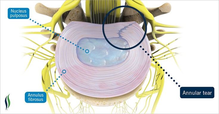 Annular Tear from Accident (Neck, Back, Spine Injury)