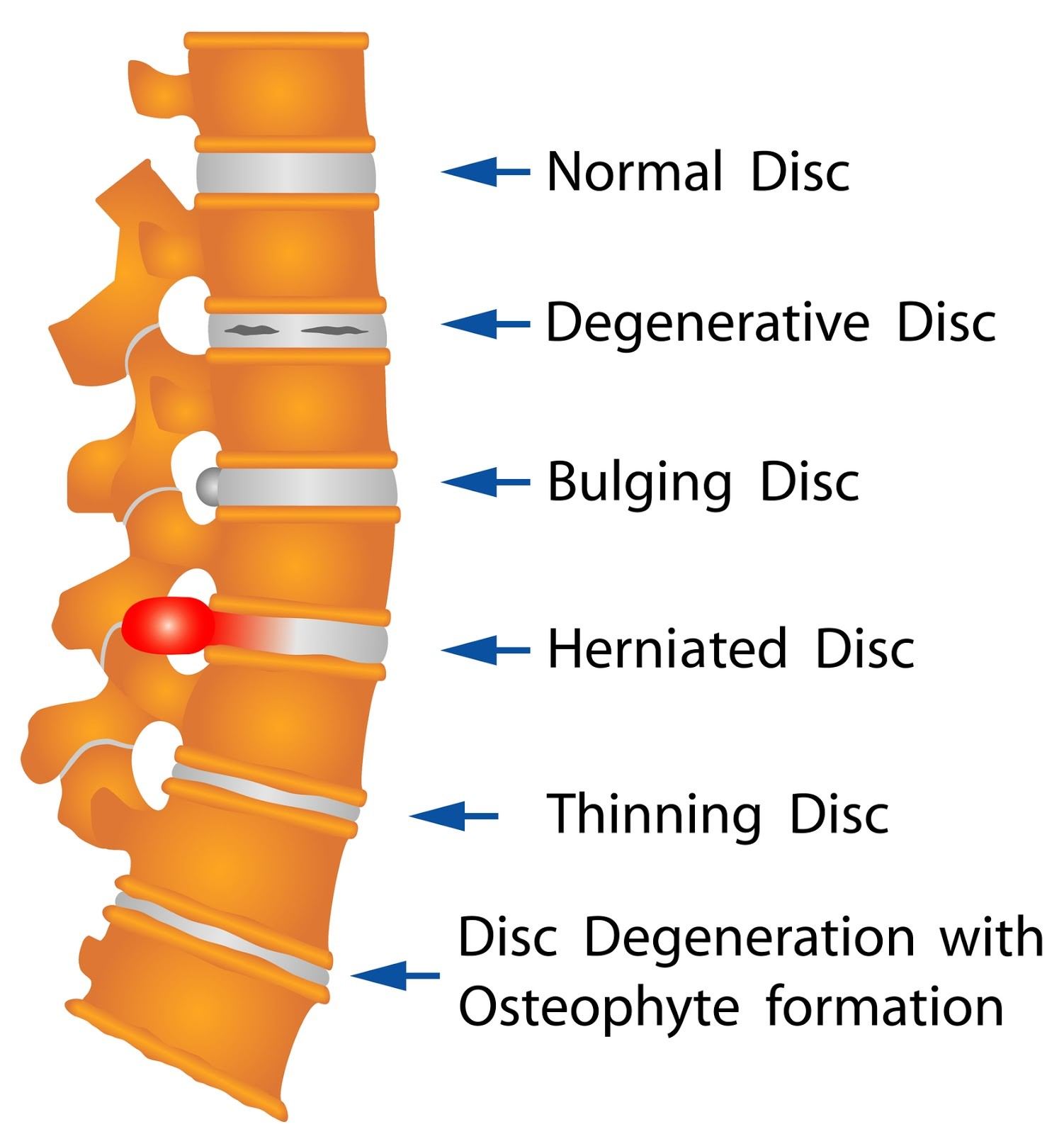 Injuries to Neck, Back, or Spine from Accident