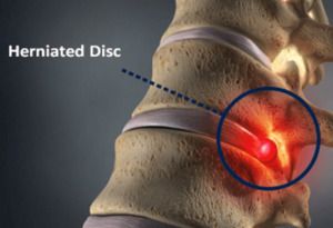 image of a herniated disc