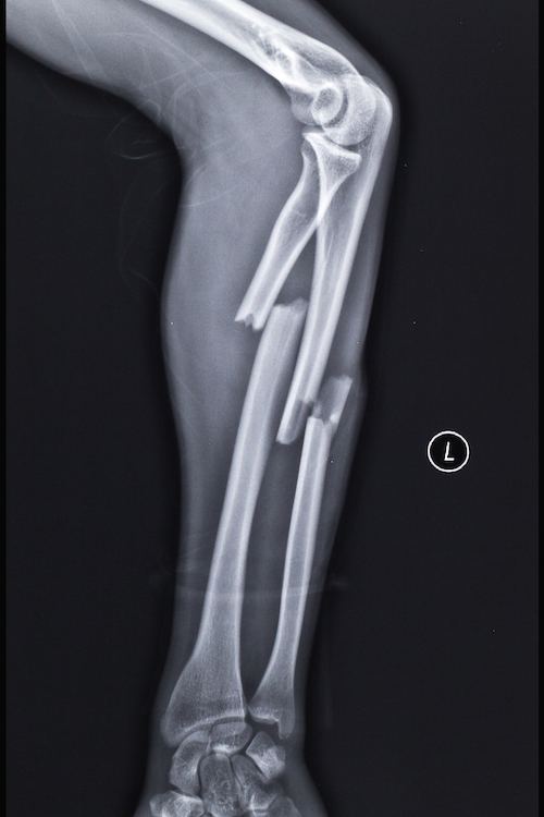 fractured bones leg injury in Georgia