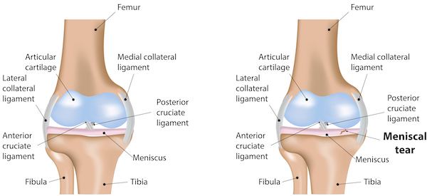 image showing how damage to a knee joint looks