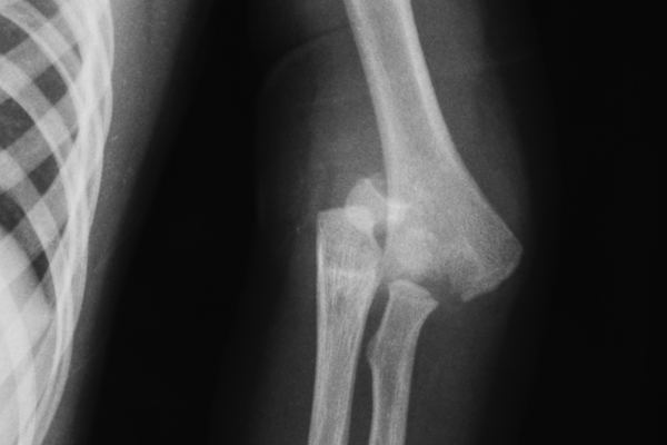 joint injury