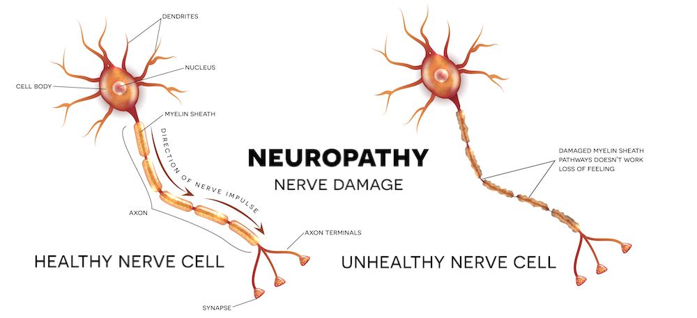 image showing how damage to a nerve looks