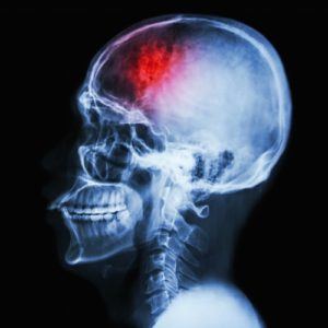 Brain scan image of a Georgia accident victim