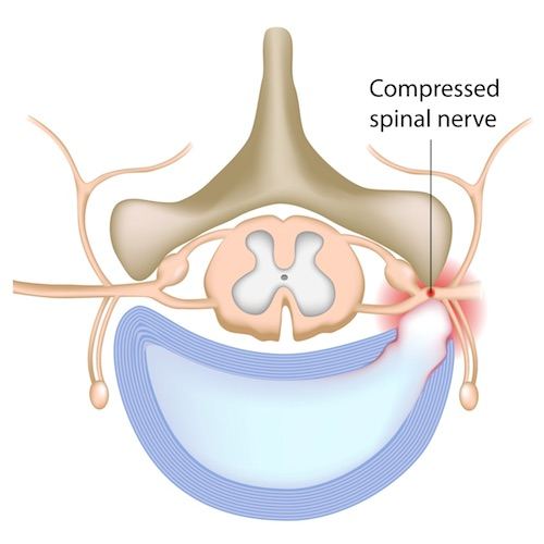Compressed spinal nerve caused by a car wreck in Georgia