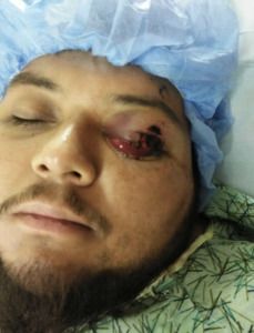 Eye Injury - Product Liability Case