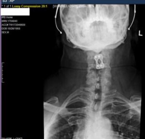 Neck X-Ray image of an Atlanta accident victim