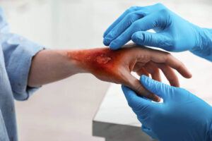 Doctor treating burn injuries of patient.
