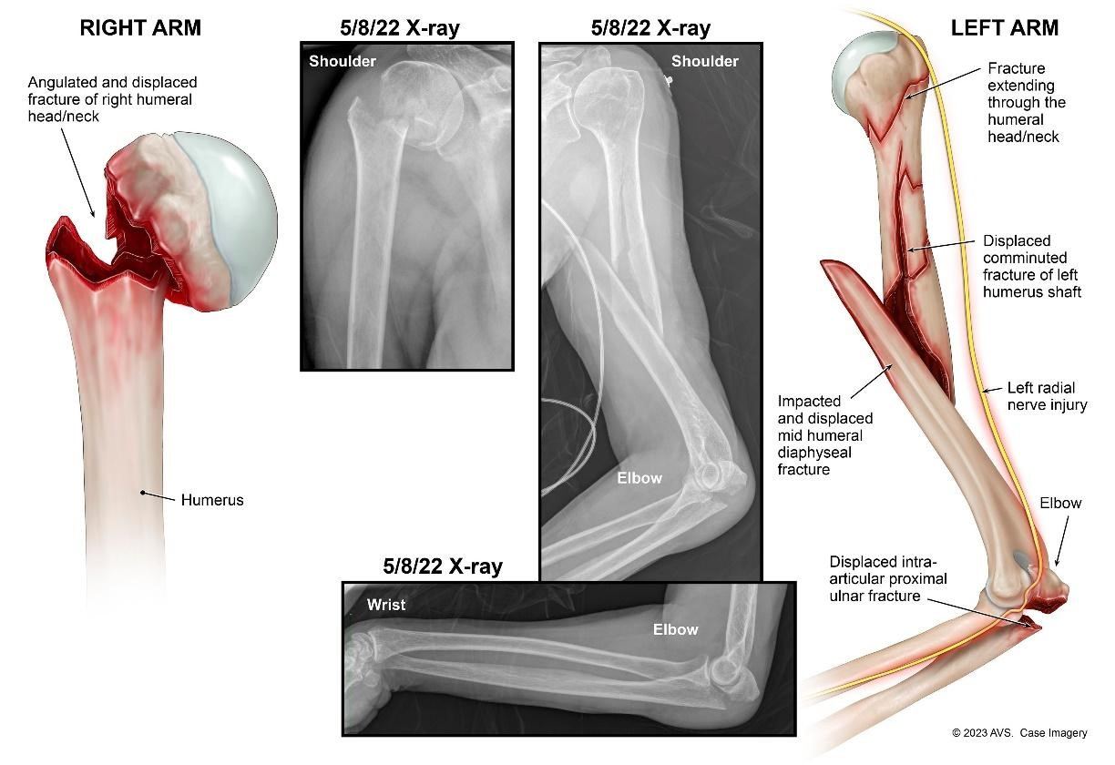 Medical illustrations show the severity of our client’s fractures in her arms