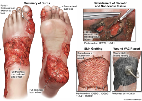 Burn Injuries